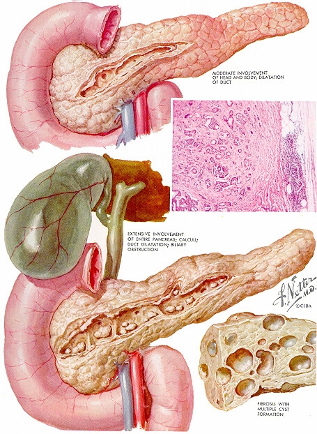 poza despre pancreatitele cronice